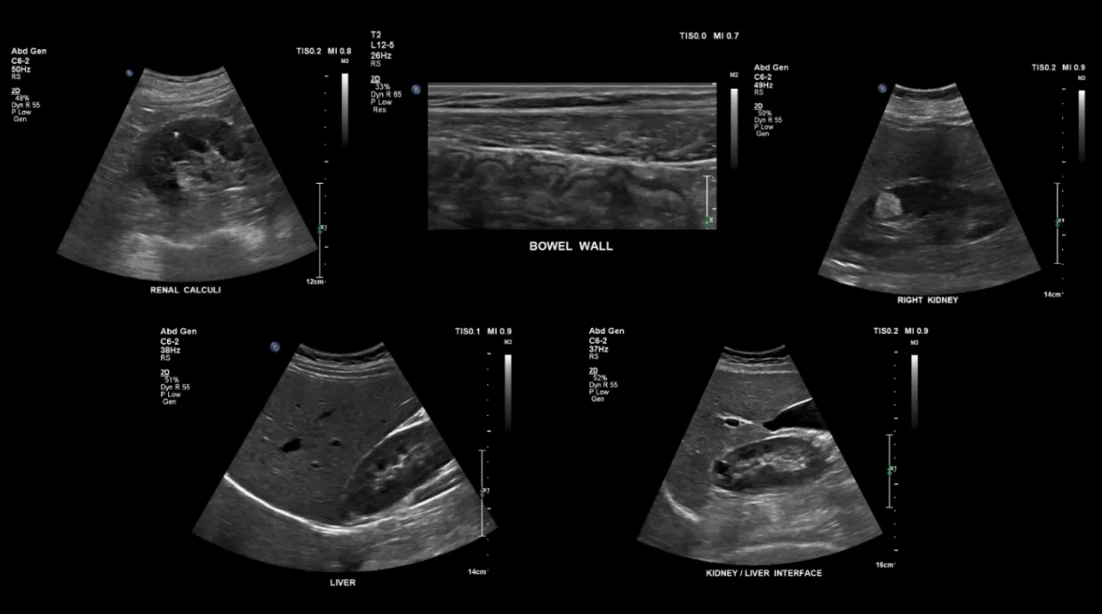 Ultrasound