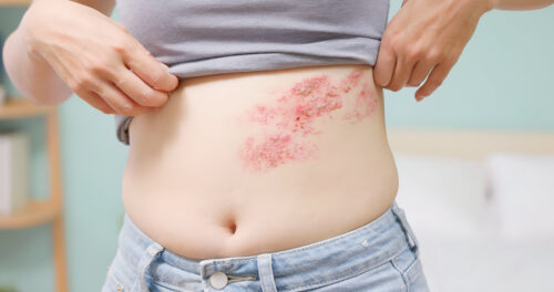 Trinity Medical Centre_Health Blog_/shingles-vaccine-guide-prevention